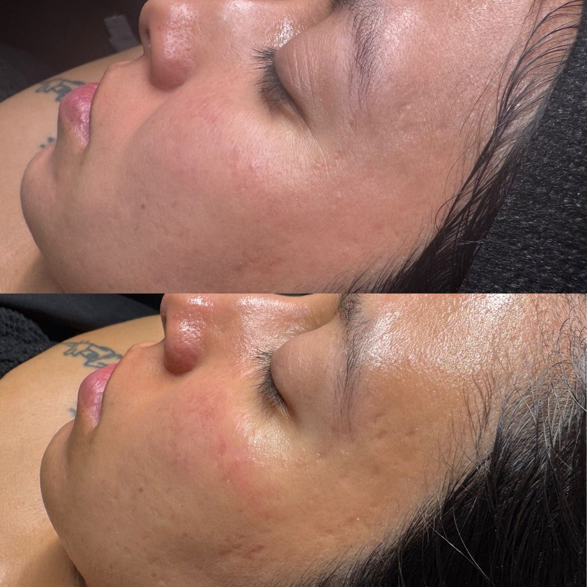 Skin clarity — before and after
